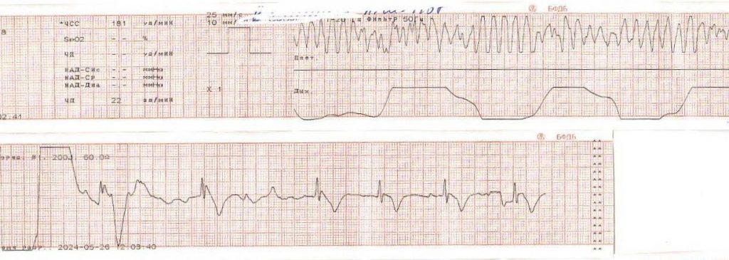 Случай из практики: успешная реанимация пациента с острым инфарктом миокарда