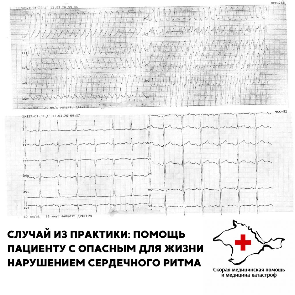 Случай из практики: помощь пациенту с опасным для жизни нарушением сердечного ритма