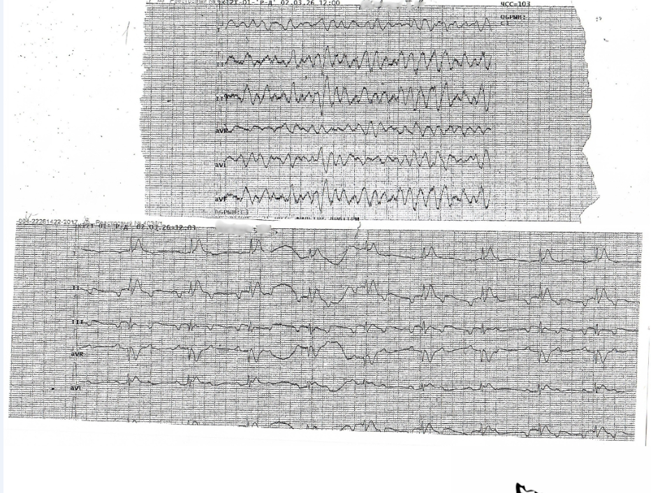 Случай из практики: успешная реанимация пациента с остановкой сердца