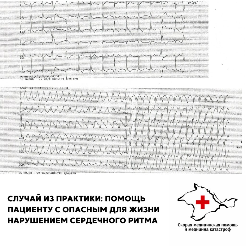 Случай из практики: помощь пациенту с опасным для жизни нарушением сердечного ритма